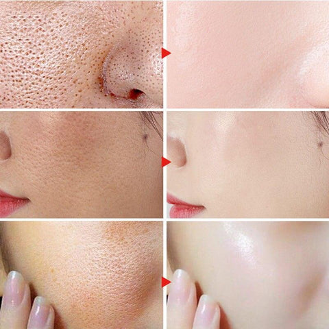 Herbal Acne Removal Face Cream - FajarShuruqSA
